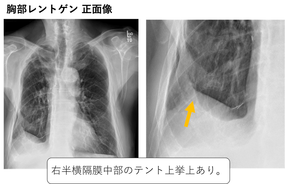 傍横隔膜隆起(juxtaphrenic peak sign)の胸部レントゲン、CT画像所見の 